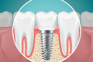 Transforming Dental Care in Montreal: How Implants are Changing Lives